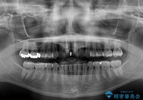 上下前歯のデコボコをきれいに インビザラインによる矯正治療の治療後