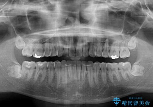 気になる前歯を治したい　短期間でのインビザライン矯正の治療後