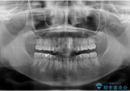 ふっくらとした口元を改善したい 目立たないワイヤー装置による抜歯矯正の治療後