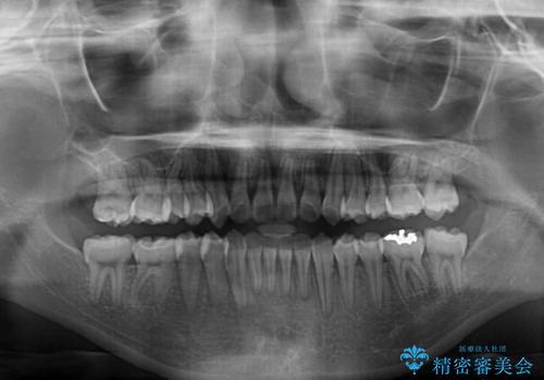 急速拡大装置で狭い歯列を骨格ごと改善 ワイヤー装置による矯正治療の治療後