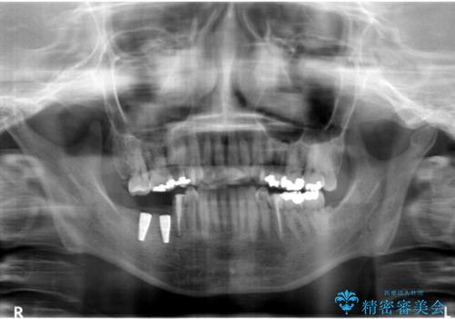 奥歯が割れている　抜歯してインプラントへ　40代女性の治療中