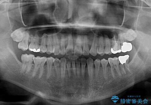 上顎の狭い歯列をインビザラインで拡大の治療後