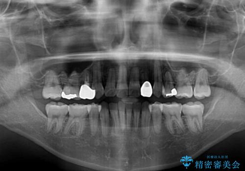 結婚式までに前歯をきれいにしたい 抜歯矯正とオールセラミッククラウンの治療後
