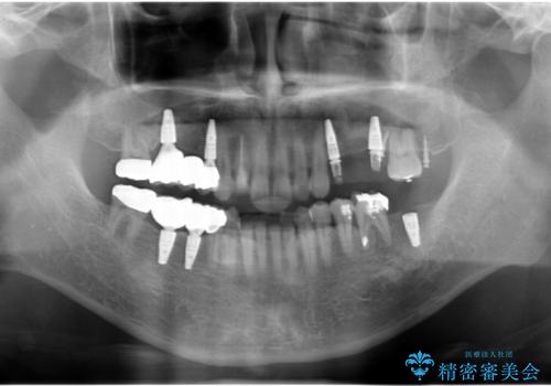 インプラント治療・セラミック治療を含む  全顎的虫歯治療の治療中