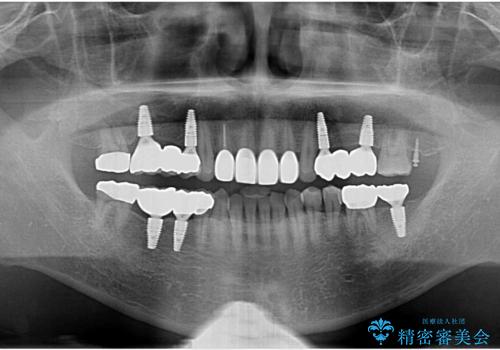 インプラント治療・セラミック治療を含む  全顎的虫歯治療