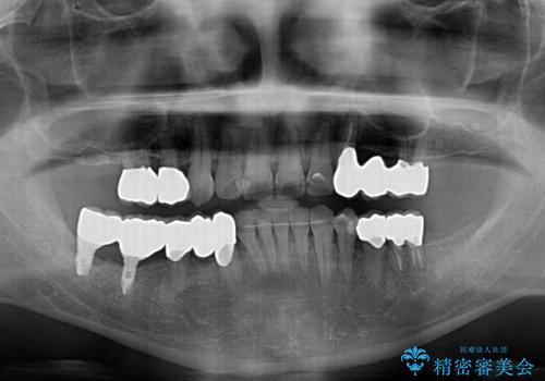 歯並びや奥歯の痛み 色々と治したい 総合歯科診療の治療後