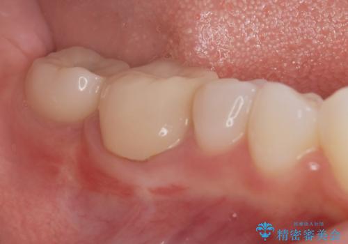 奥歯のインプラント治療の症例 治療後