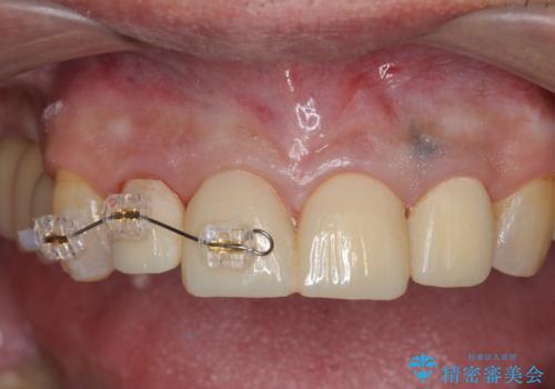 インプラント治療・セラミック治療を含む  全顎的虫歯治療の治療中