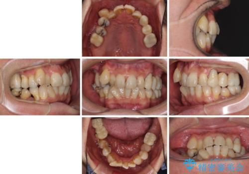 歯並びや奥歯の痛み 色々と治したい 総合歯科診療の治療前