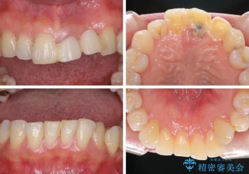 口元の突出感を治したい　治療中の歯も治したいの治療前