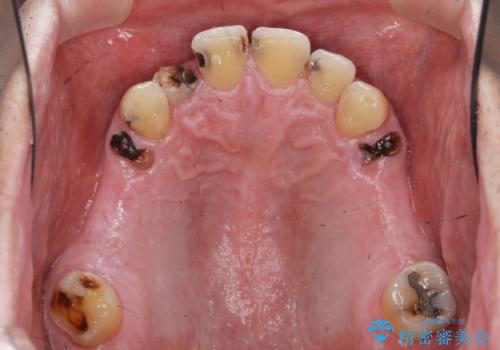 インプラント治療・セラミック治療を含む  全顎的虫歯治療の治療前