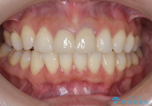 前歯が疼く セラミッククラウンのやり替えの治療後