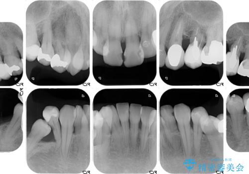 歯並びや奥歯の痛み 色々と治したい 総合歯科診療の治療前