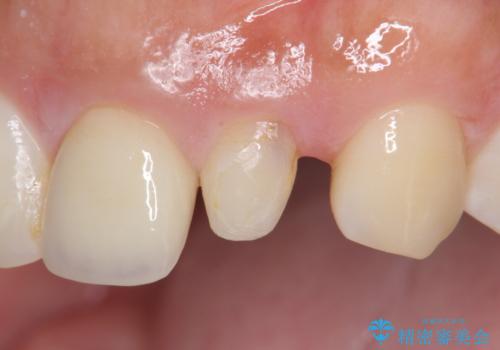 [ 歯が小さい ] 根管治療を伴う矮小歯治療の症例 治療前