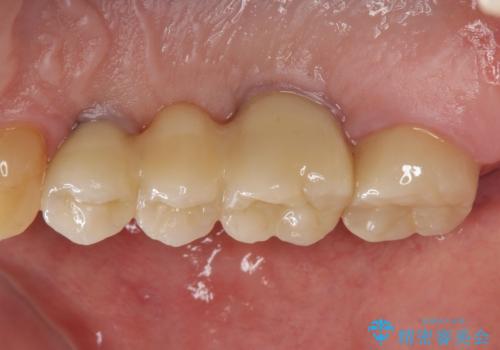 インプラント治療・セラミック治療を含む  全顎的虫歯治療の治療後