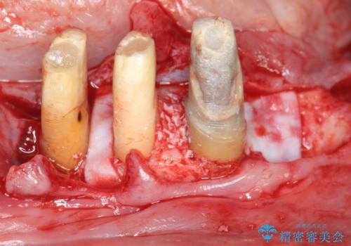 「 歯周病 再生治療 」再生治療で歯を残すの治療中