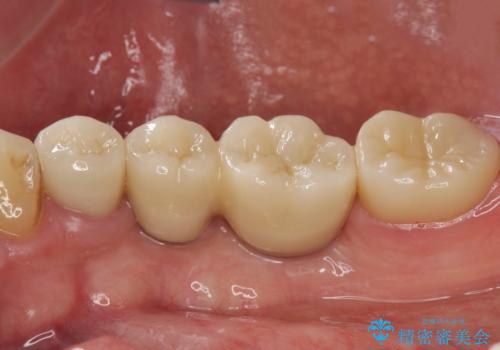 インプラント治療・セラミック治療を含む  全顎的虫歯治療の治療後