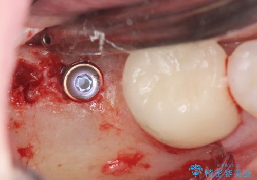 奥歯のインプラント治療の治療中