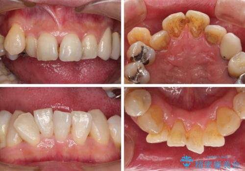 歯並びや奥歯の痛み　色々と治したい　総合歯科診療の治療前