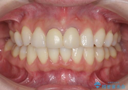 前歯が疼く セラミッククラウンのやり替えの治療前