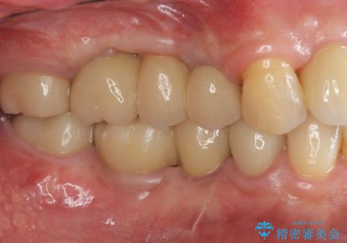 インプラント治療・セラミック治療を含む  全顎的虫歯治療の治療後