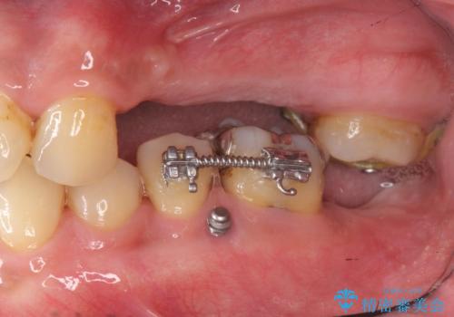 インプラント治療・セラミック治療を含む  全顎的虫歯治療の治療中