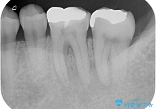 根管治療から被せ物の治療の治療前