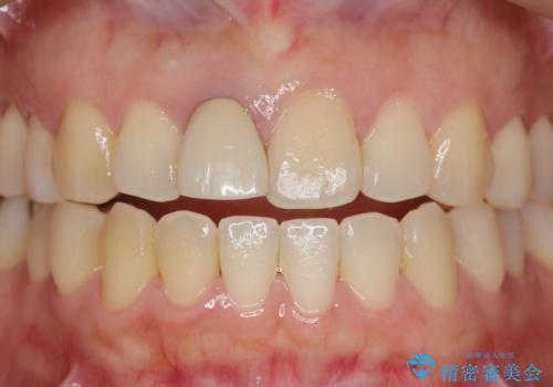 オーダーメイドで造る、自然な前歯セラミッククラウンの治療前