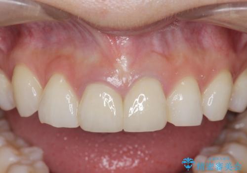 前歯が疼く セラミッククラウンのやり替えの治療後