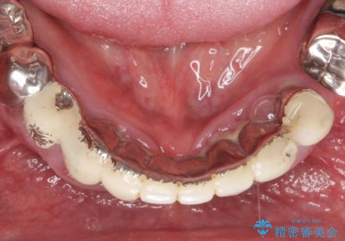 「 歯周病 再生治療 」再生治療で歯を残すの治療前
