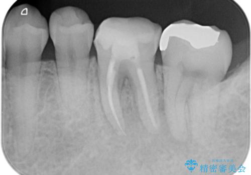 根管治療から被せ物の治療の治療後