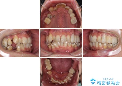 歯並びや奥歯の痛み 色々と治したい 総合歯科診療の治療前