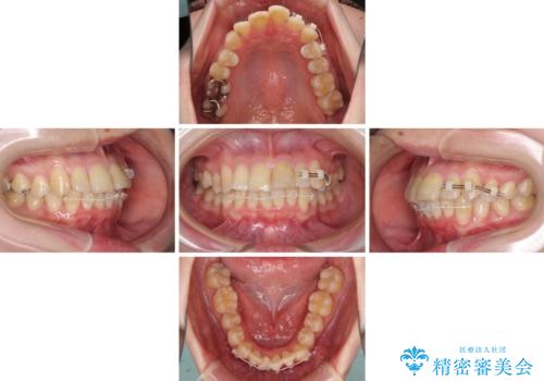 上下前歯のデコボコをきれいに インビザラインによる矯正治療の治療中