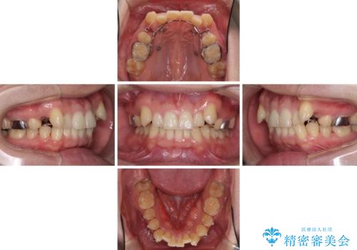 気になる八重歯を抜歯矯正で改善 補助装置を用いたインビザライン矯正の治療中