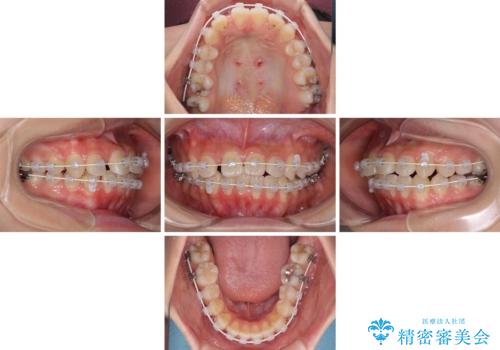 急速拡大装置で狭い歯列を骨格ごと改善 ワイヤー装置による矯正治療の治療中