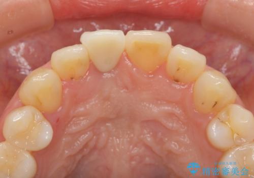 オーダーメイドで造る、自然な前歯セラミッククラウンの治療後