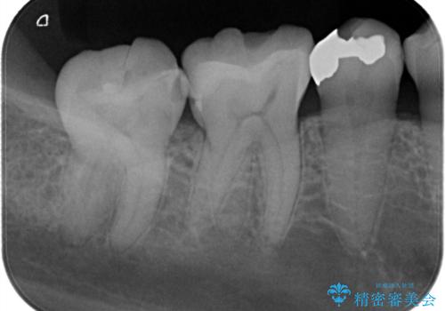 保険診療のCRインレーをセラミックインレーでやり直しの治療前