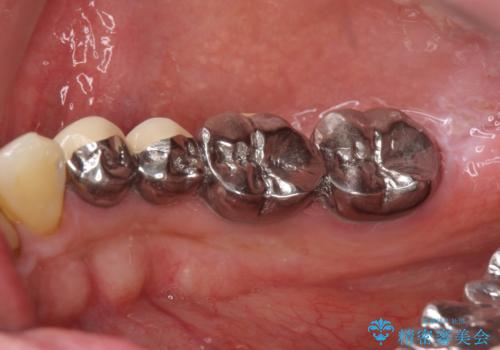 インプラント治療・セラミック治療を含む  全顎的虫歯治療の治療前