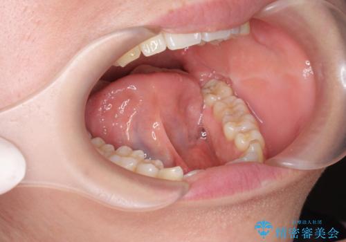 [ 舌小帯の形成 ]滑舌を改善したいの治療前