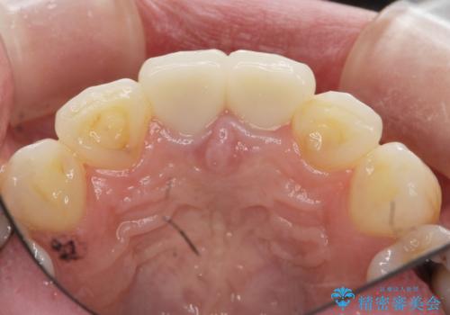 前歯が疼く セラミッククラウンのやり替えの治療後