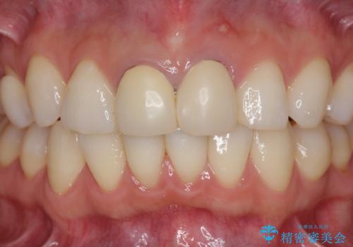 前歯が疼く セラミッククラウンのやり替えの治療前