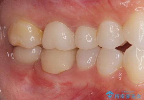 奥歯のインプラント治療の治療後