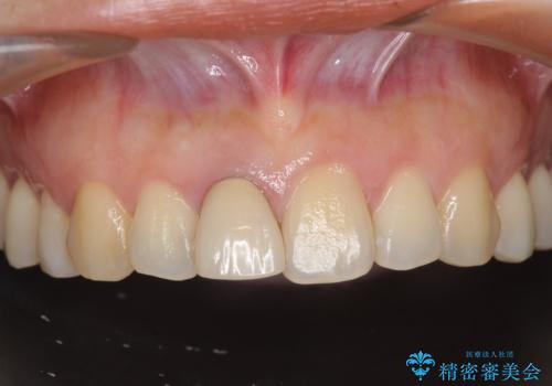 オーダーメイドで造る、自然な前歯セラミッククラウンの症例 治療前