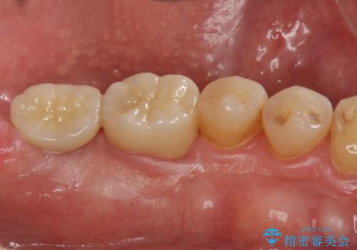 インプラント治療・セラミック治療を含む  全顎的虫歯治療の治療後