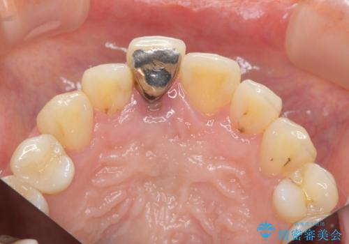 オーダーメイドで造る、自然な前歯セラミッククラウンの治療前