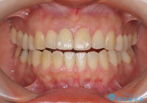 オーダーメイドで造る、自然な前歯セラミッククラウンの治療後