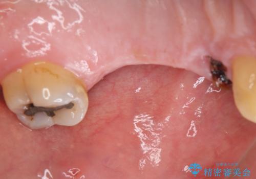 インプラント治療・セラミック治療を含む  全顎的虫歯治療の治療前