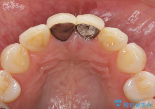 前歯が疼く セラミッククラウンのやり替えの治療前