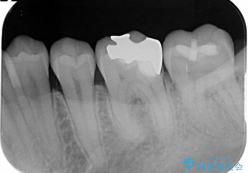 【セラミックインレー】虫歯の治療の治療前