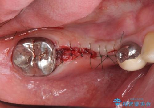 長いブリッジをインプラント補綴への変更の治療中